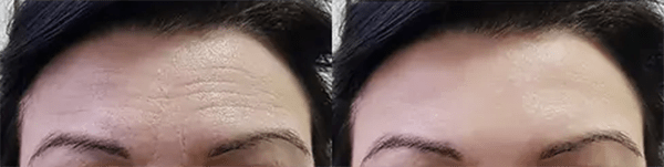 Botox® Before and After Photo by Forward Healthy Lifestyles in Germantown, WI