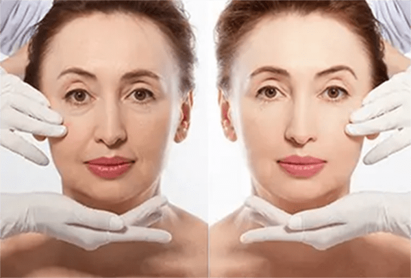 Dermal Fillers Before and After Photo by Forward Healthy Lifestyles in Germantown, WI