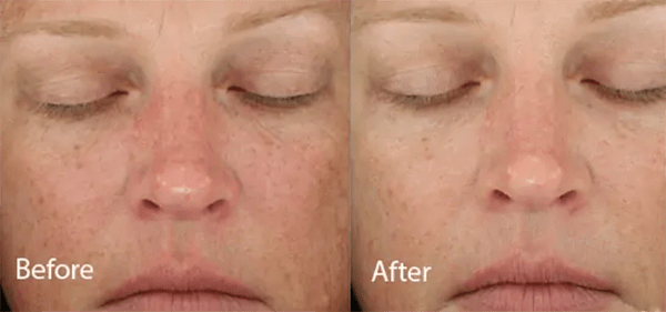 DiamondGlow® Before and After Photo by Forward Healthy Lifestyles in Germantown, WI