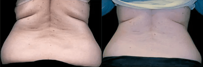 BTL Exilis Ultra™ Before and After Photo by Forward Healthy Lifestyles in Germantown, WI