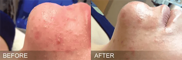 HydraFacial Before and After Photo by Forward Healthy Lifestyles in Germantown, WI