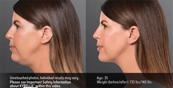 Kybella Before and After Photo by Forward Healthy Lifestyles in Germantown, WI
