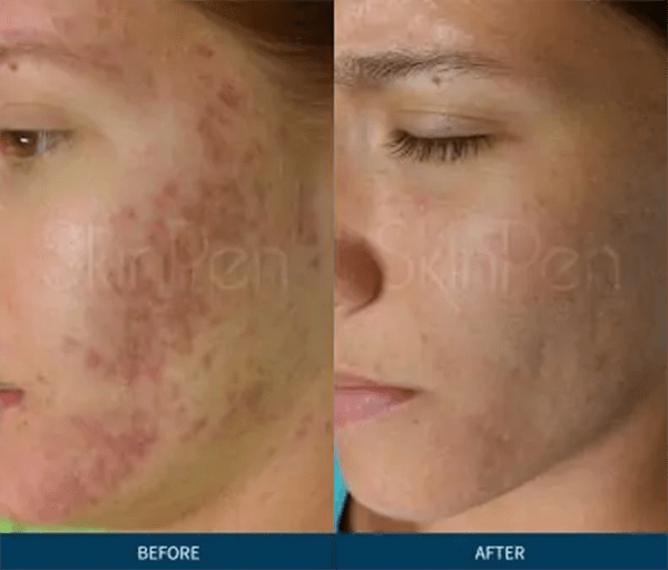 Microneedling Before and After Photo by Forward Healthy Lifestyles in Germantown, WI