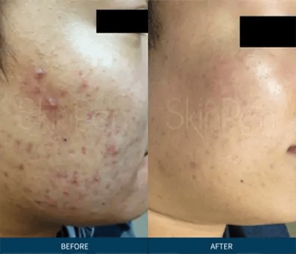 Microneedling Before and After Photo by Forward Healthy Lifestyles in Germantown, WI