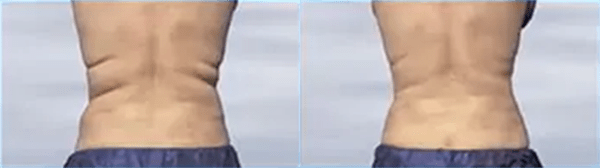CoolSculpting® Before and After Photo by Forward Healthy Lifestyles in Germantown, WI