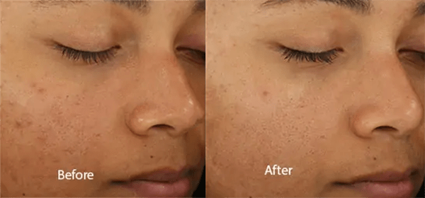 DiamondGlow® Before and After Photo by Forward Healthy Lifestyles in Germantown, WI