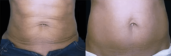 BTL Exilis Ultra™ Before and After Photo by Forward Healthy Lifestyles in Germantown, WI