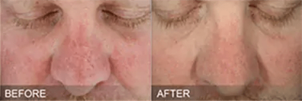 HydraFacial Before and After Photo by Forward Healthy Lifestyles in Germantown, WI