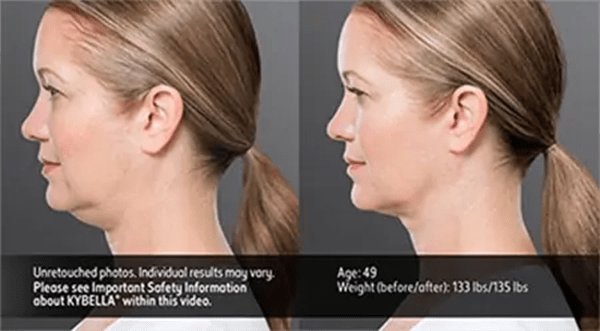 Kybella Before and After Photo by Forward Healthy Lifestyles in Germantown, WI