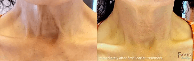 Scarlet Microneedling for Skin Elasticity Before and After Photo by Forward Healthy Lifestyles in Germantown, WI