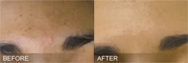 HydraFacial Before and After Photo by Forward Healthy Lifestyles in Germantown, WI
