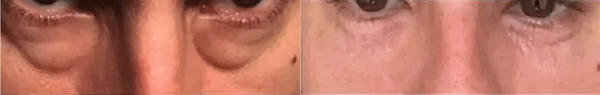 Agnes RF Before and After Photo by Forward Healthy Lifestyles in Germantown, WI