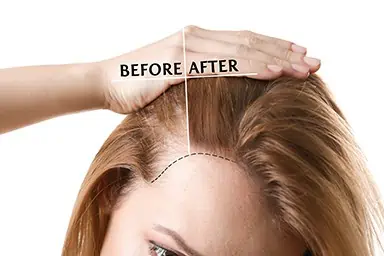 Hair Loss Therapy Washington County, WI