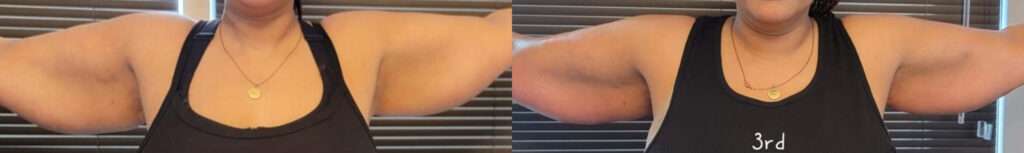 BTL Exilis Ultra™ Before and After Photo by Forward Healthy Lifestyles in Germantown, WI