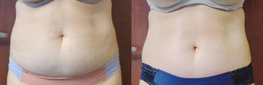 BTL Exilis Ultra™ Before and After Photo by Forward Healthy Lifestyles in Germantown, WI