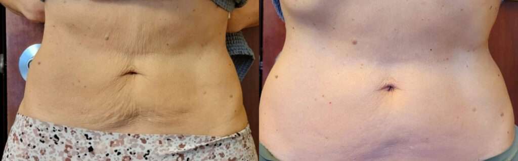 BTL Exilis Ultra™ Before and After Photo by Forward Healthy Lifestyles in Germantown, WI