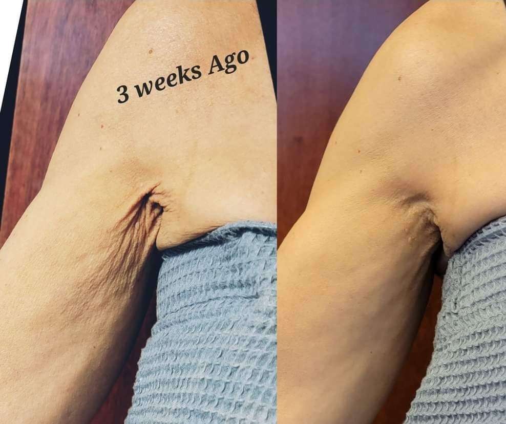 BTL Exilis Ultra™ Before and After Photo by Forward Healthy Lifestyles in Germantown, WI