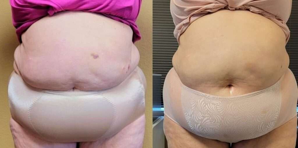 BTL Exilis Ultra™ Before and After Photo by Forward Healthy Lifestyles in Germantown, WI