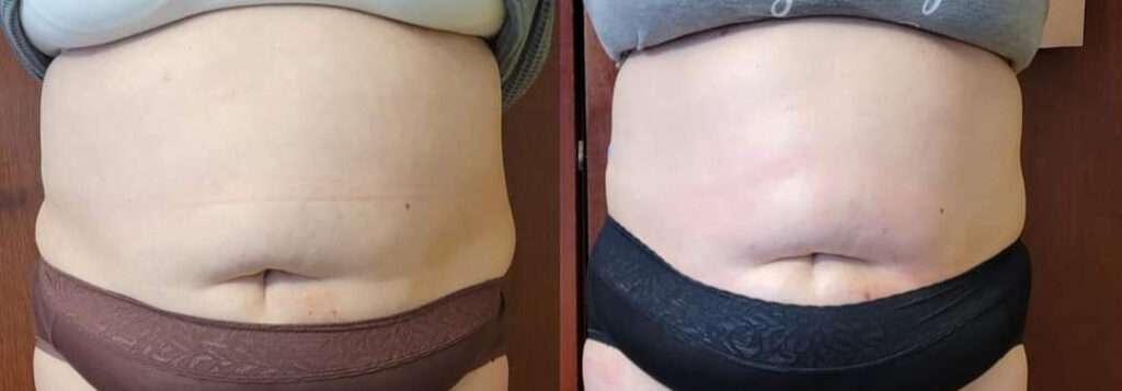 BTL Exilis Ultra™ Before and After Photo by Forward Healthy Lifestyles in Germantown, WI
