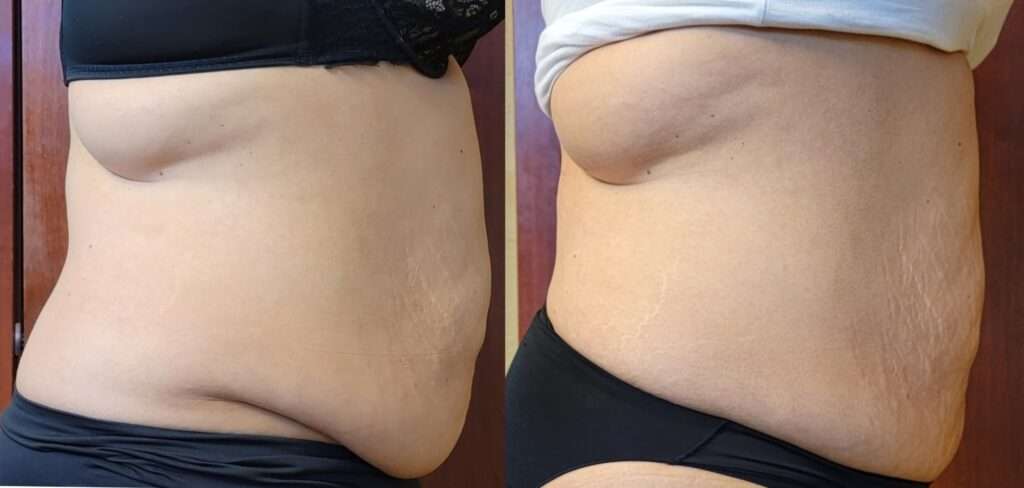 BTL Exilis Ultra™ Before and After Photo by Forward Healthy Lifestyles in Germantown, WI