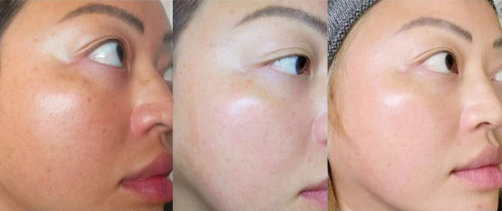 Chemical Peels Before and After Photo by Forward Healthy Lifestyles in Germantown, WI