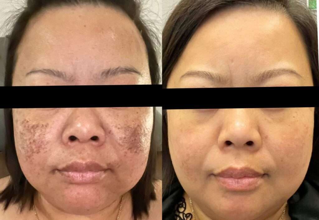 IPL Before and After Photo by Forward Healthy Lifestyles in Germantown, WI