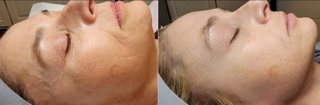 Microneedling Before and After Photo by Forward Healthy Lifestyles in Germantown, WI