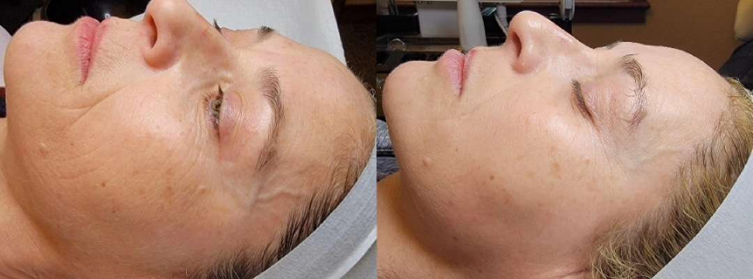Microneedling Before and After Photo by Forward Healthy Lifestyles in Germantown, WI