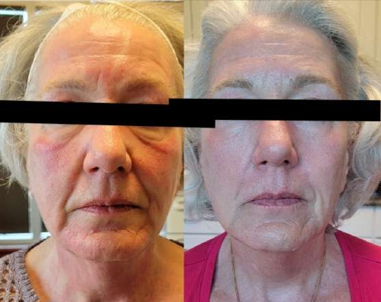 Microneedling Before and After Photo by Forward Healthy Lifestyles in Germantown, WI