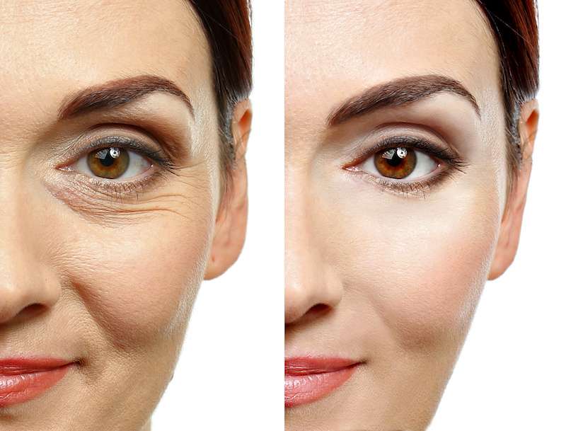 Before and after results of botox procedure