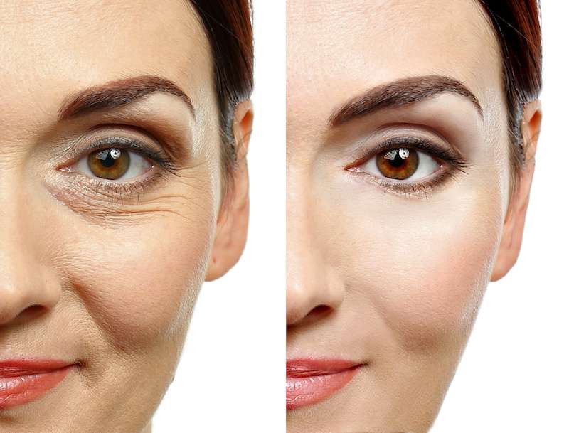 Woman face before and after cosmetic procedure. Plastic surgery concept. Before and after results of botox procedure