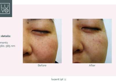 LUCENT IPL Before & After