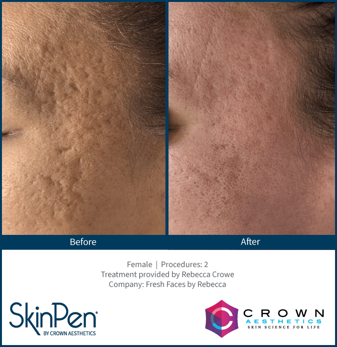 BA-SkinPen-Acne_FreshFaces_RebeccaCrow Before and after skinpen
