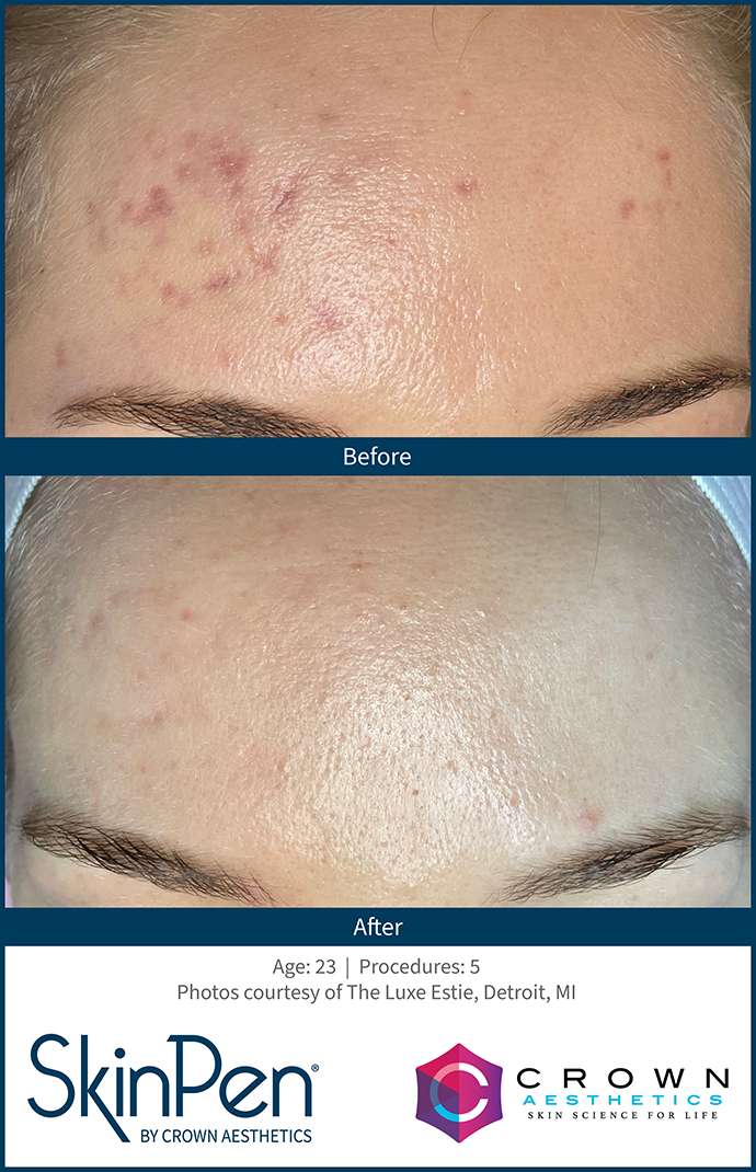 BA-SkinPen-TheLuxeEstie_Set2_Age23_Treatments5 Before and after skinpen