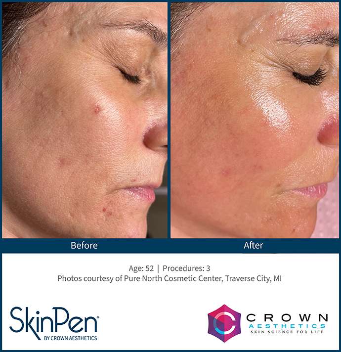 Before and after skinpen