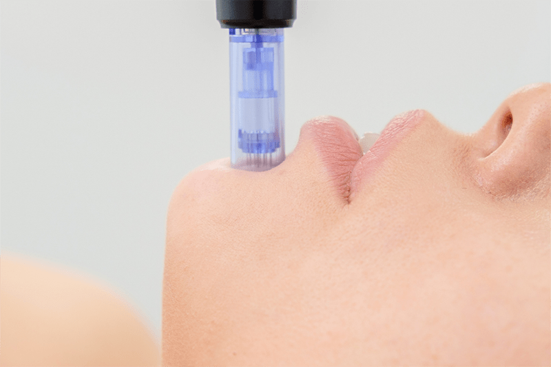 microneedling to her chin microneedling to her chin