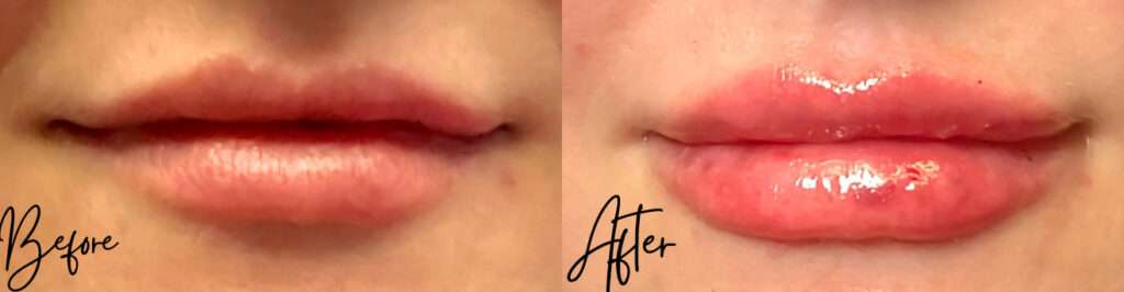 Revanesse Versa Filler - Lips before and after