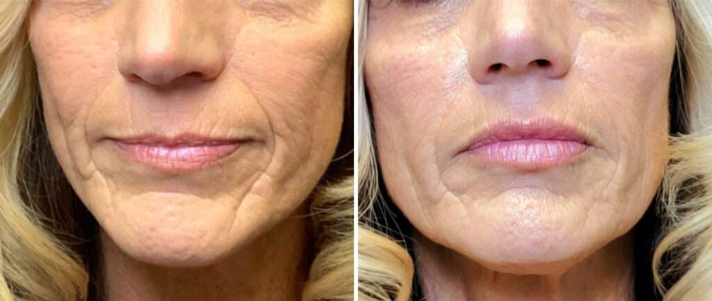 Before and after images of a patient that got Cheek and Lip Fillers at Forward Healthy Lifestyles