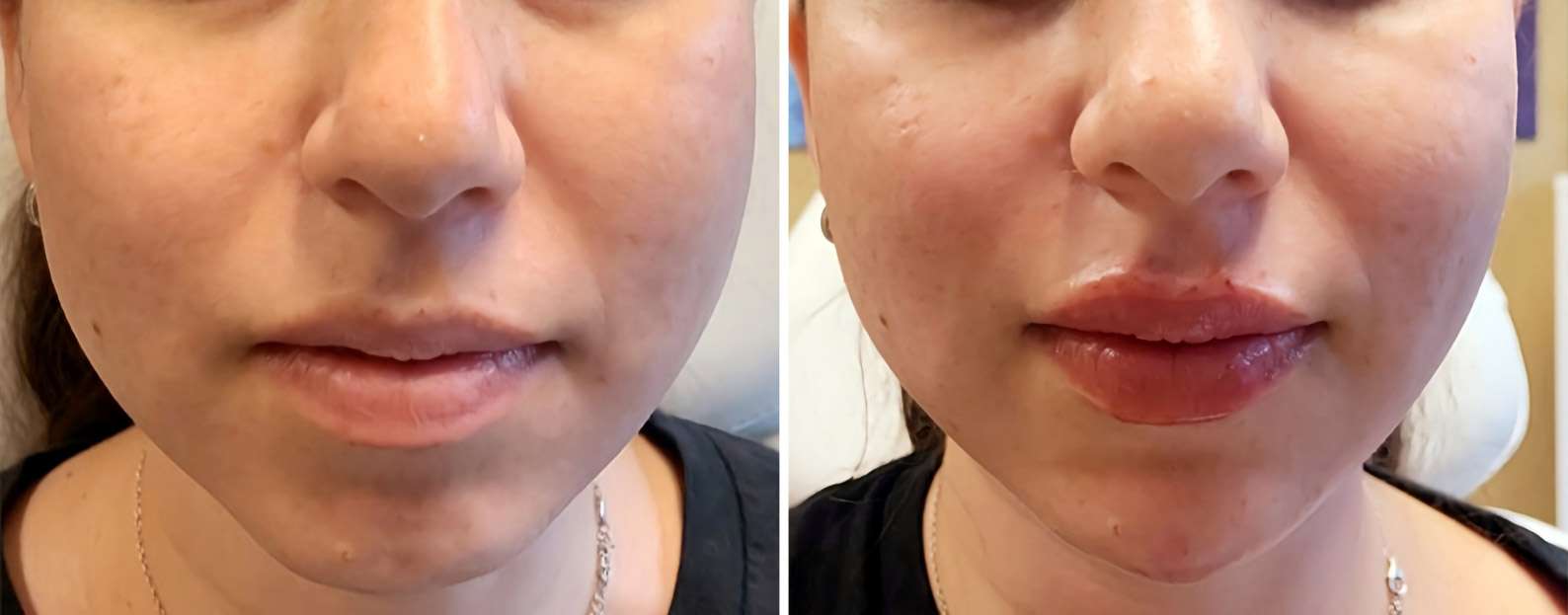 Before and after images of a patient that got Chin and Lip Fillers at Forward Healthy Lifestyles