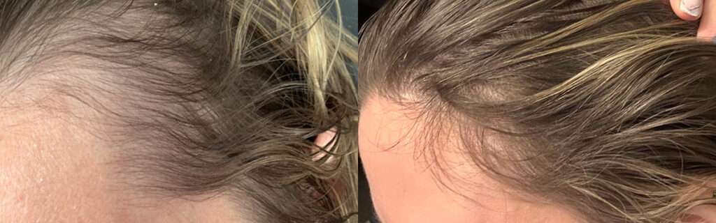 Hair Restoration Before and After Photo by Forward Healthy Lifestyles in Germantown, WI