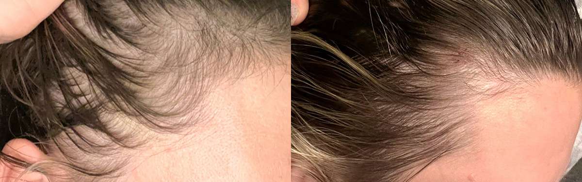 Hair Restoration Before and After Photo by Forward Healthy Lifestyles in Germantown, WI
