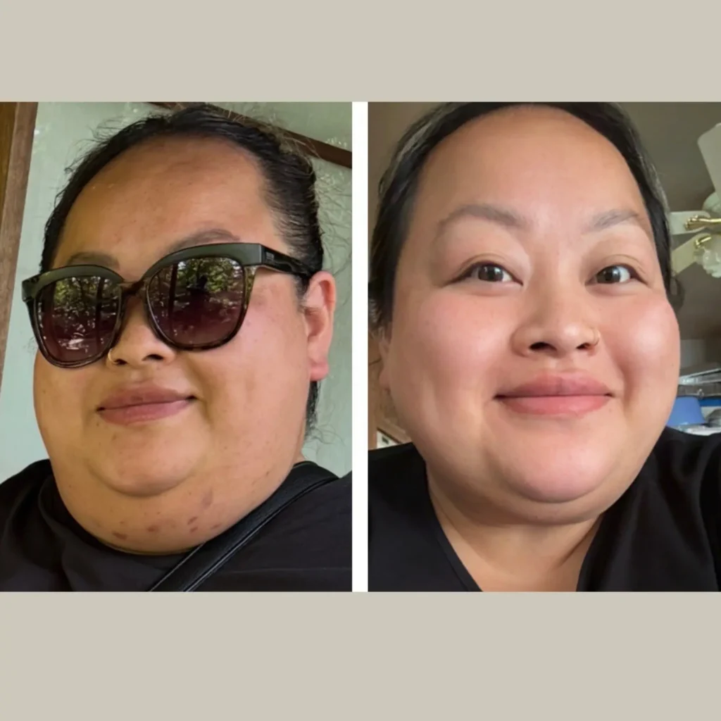 kybella before and after photo by forward healthy lifestyles in germantown wi