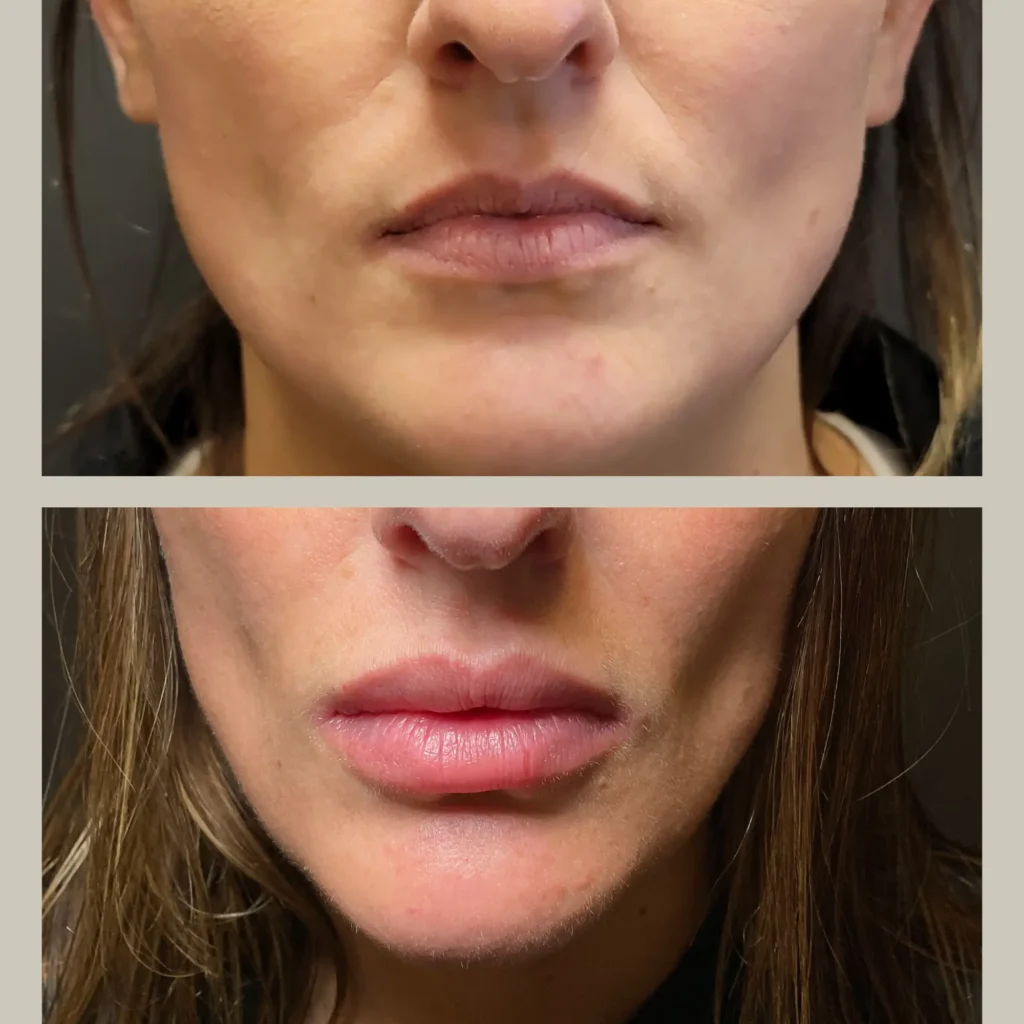 fillers before and after photo by forward healthy lifestyles in germantown wi