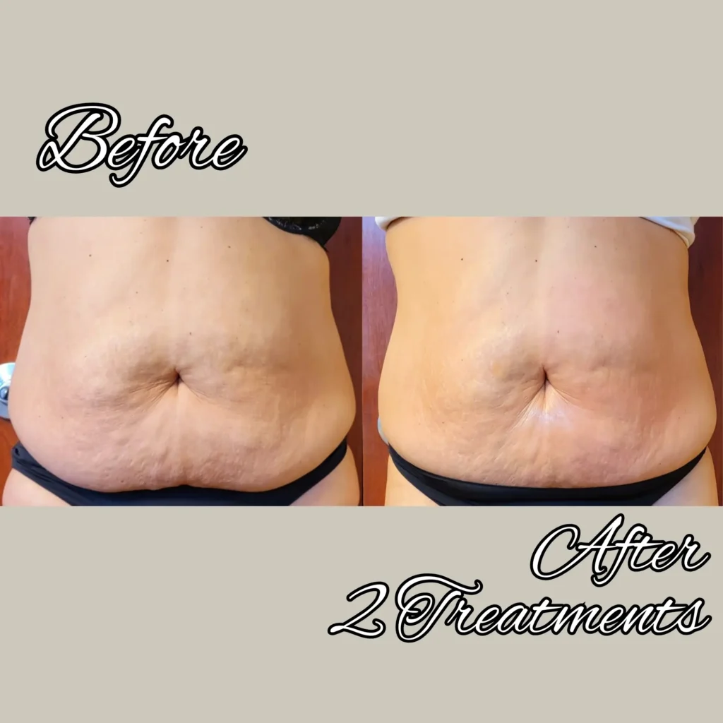 btl exilis ultra before and after photo by forward healthy lifestyles in shorewood wi