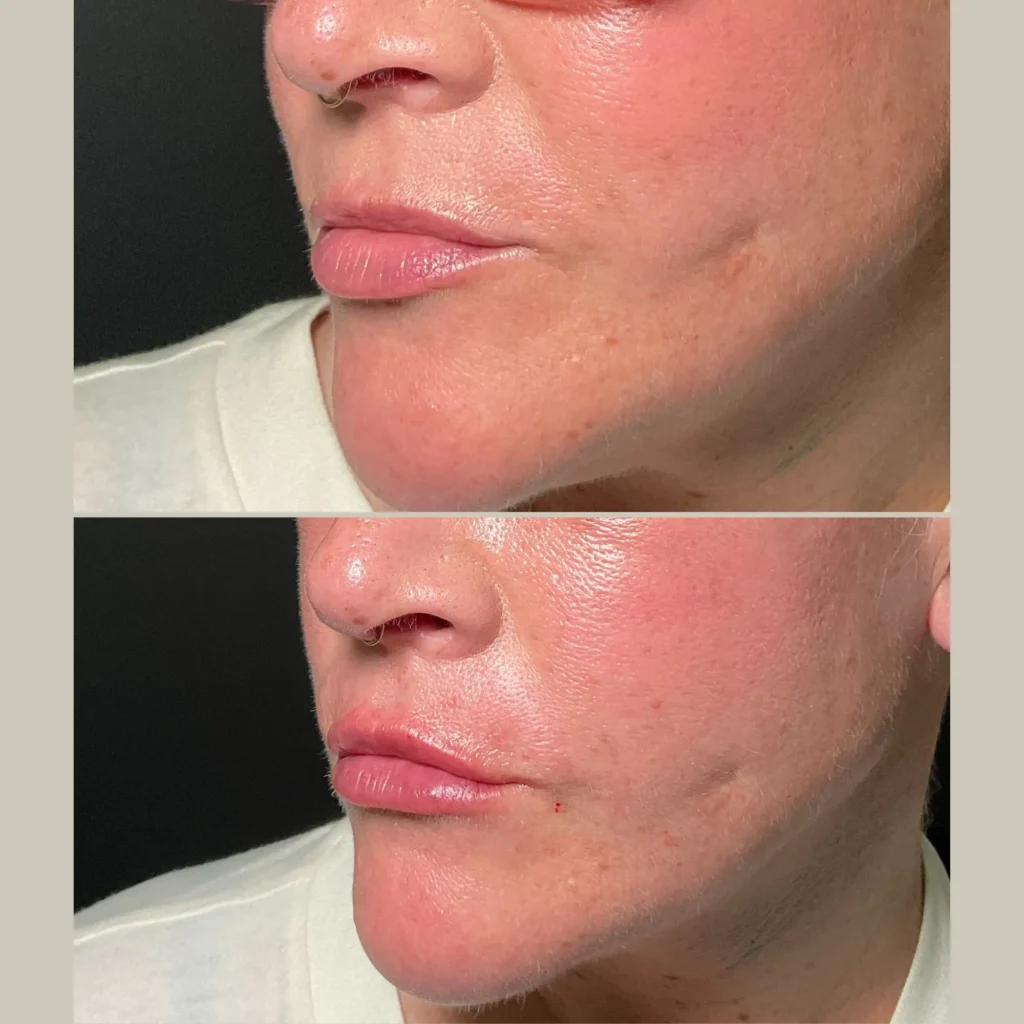 fillers before and after photo by forward healthy lifestyles in germantown wi