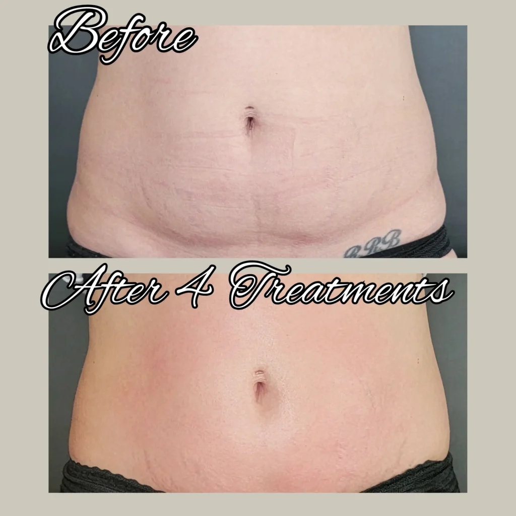 btl exilis ultra before and after photo by forward healthy lifestyles in shorewood wi