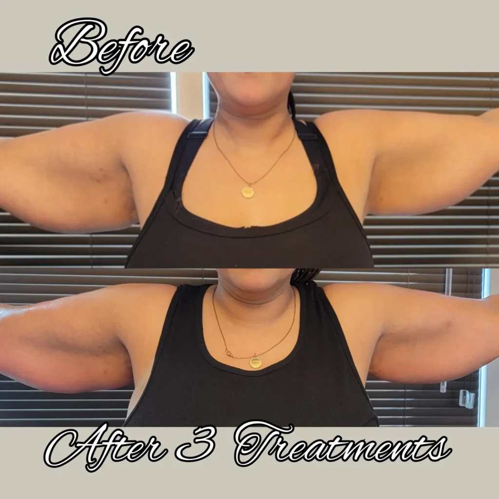 btl exilis ultra before and after photo by forward healthy lifestyles in shorewood wi
