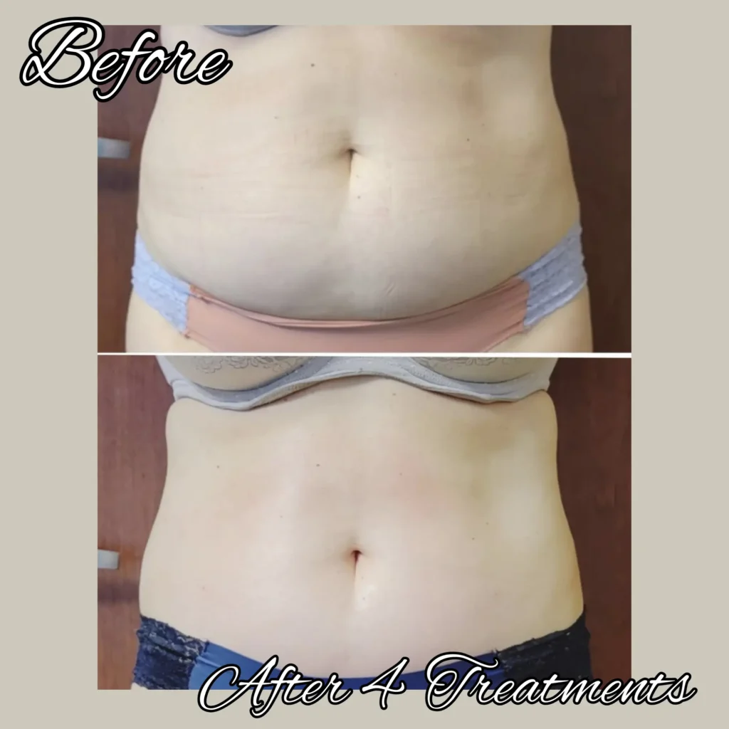 btl exilis ultra before and after photo by forward healthy lifestyles in shorewood wi