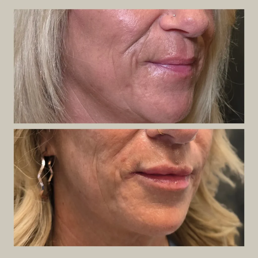 fillers before and after photo by forward healthy lifestyles in germantown wi