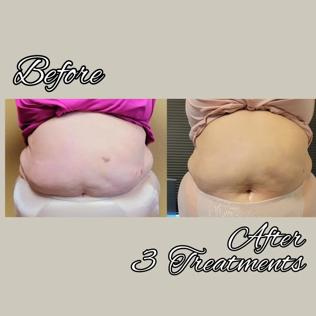 btl exilis ultra before and after photo by forward healthy lifestyles in shorewood wi